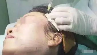 女子线雕手术三年后脸上钻出一根线